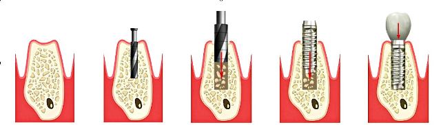 implanty zębów w Krakowie